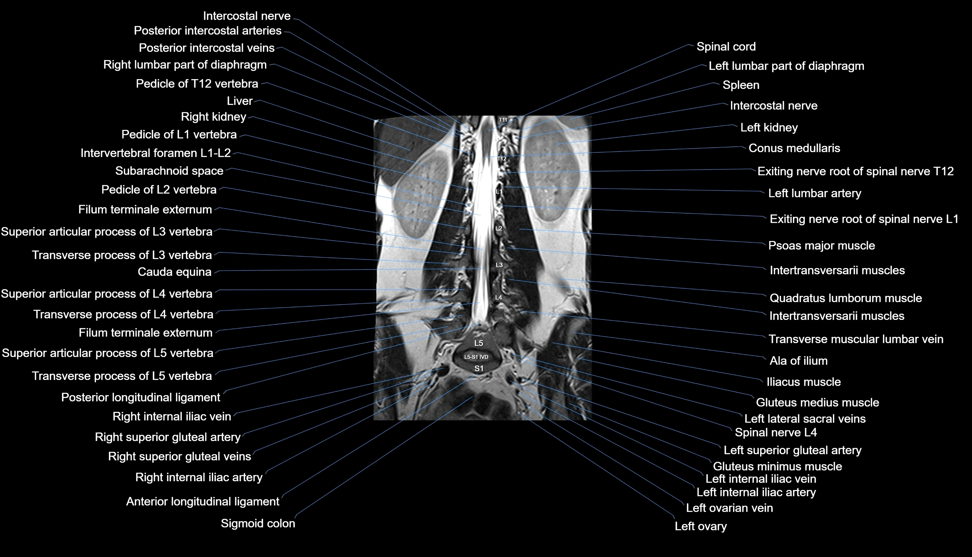 MRI lumbar spine labelled coronal cross sectional anatomy 3T radiology-img-00001-00019.webp